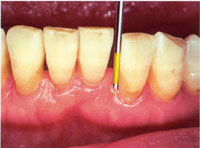 歯周病治療|三塚歯科クリニック