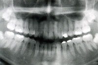 歯周病治療|三塚歯科クリニック