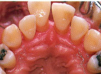 歯周病治療|三塚歯科クリニック