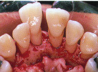 歯周病治療|三塚歯科クリニック