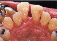 歯周病治療|三塚歯科クリニック