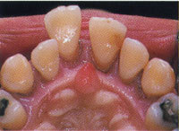歯周病治療|三塚歯科クリニック